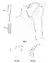 Fig. 07 - Arthroscopic total shoulder arthroplasty