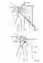 Fig. 09 - Arthroscopic total shoulder arthroplasty