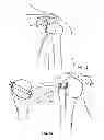 Fig. 10 - Arthroscopic total shoulder arthroplasty