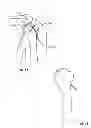 Fig. 12 - Arthroscopic total shoulder arthroplasty