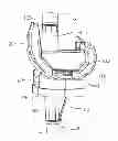 Fig. 01 - Knee Revision Prosthesis With Progressive Restraint