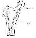 Fig. 01 - Hip joint prosthesis