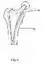 Fig. 03 - Hip joint prosthesis
