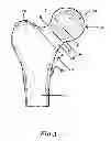 Fig. 04 - Hip joint prosthesis