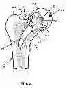 Fig. 05 - Hip joint prosthesis