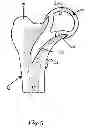 Fig. 06 - Hip joint prosthesis