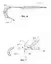 Fig. 07 - GROOVED PANCREATIC STENT