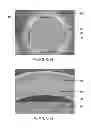 Fig. 09 - Surface improvement on electric discharge machined titanium alloy miniature parts for implantable medical device