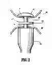 Fig. 04 - Seal element for anastomosis