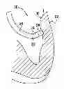 Fig. 01 - Catheter with bendable tip