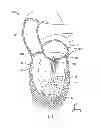 Fig. 02 - CATHETER-BASED ANNULOPLASTY USING VENTRICULARLY POSITIONED CATHETER