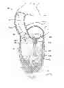 Fig. 07 - CATHETER-BASED ANNULOPLASTY USING VENTRICULARLY POSITIONED CATHETER