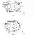 Fig. 09 - CATHETER-BASED ANNULOPLASTY USING VENTRICULARLY POSITIONED CATHETER