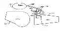Fig. 01 - Method and System for Patella Realignment