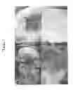 Fig. 04 - Joint repair using mesenchymal stem cells
