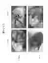 Fig. 07 - Joint repair using mesenchymal stem cells