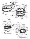 Fig. 02 - Stabilizing vertebrae with expandable spacers