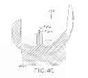 Fig. 13 - Tibial bearing component for a knee prosthesis with improved articular characteristics