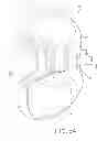 Fig. 14 - Tibial bearing component for a knee prosthesis with improved articular characteristics