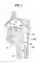 Fig. 02 - Tongue suspension device and method
