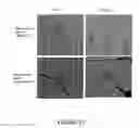 Fig. 22 - LONG NON-CODING RNA SPRY4-IT1 AS A DIAGNOSTIC AND THERAPEUTIC AGENT