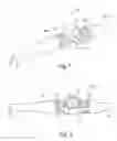 Fig. 02 - IMPLANTABLE ANCHOR WITH LOCKING CAM