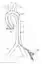 Fig. 01 - System for deploying a device to a distal location across a diseased vessel