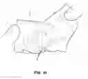 Fig. 02 - System for deploying a device to a distal location across a diseased vessel