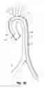 Fig. 08 - System for deploying a device to a distal location across a diseased vessel