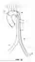 Fig. 40 - System for deploying a device to a distal location across a diseased vessel