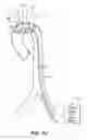 Fig. 41 - System for deploying a device to a distal location across a diseased vessel