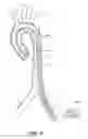 Fig. 44 - System for deploying a device to a distal location across a diseased vessel