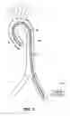 Fig. 45 - System for deploying a device to a distal location across a diseased vessel