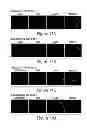Fig. 31 - Compositions, kits and methods for treatment of complement-related disorders