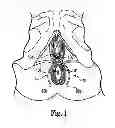 Fig. 02 - Method of treating anal incontinence
