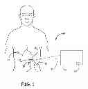 Fig. 02 - CHRONICALLY IMPLANTED ABDOMINAL PRESSURE SENSOR FOR CONTINUOUS AMBULATORY ASSESSMENT OF RENAL FUNCTIONS