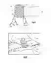 Fig. 03 - Wound dressing for finger/penis and method/system of delivery
