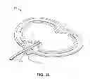 Fig. 08 - Reduced pressure therapy of the sacral region