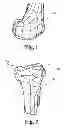 Fig. 02 - Devices and methods for performing knee arthroplasty