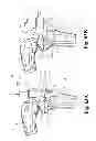 Fig. 45 - Devices and methods for performing knee arthroplasty