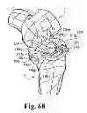 Fig. 50 - Devices and methods for performing knee arthroplasty