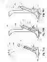 Fig. 52 - Devices and methods for performing knee arthroplasty