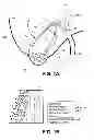 Fig. 02 - DEVICES AND METHODS TO TREAT GALLSTONE DISEASE