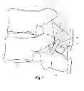Fig. 02 - Interspinous spacers and associated methods of use and manufacture