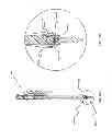 Fig. 20 - Spine stabilization system