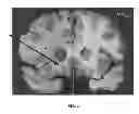 Fig. 02 - Method for treating neurological /psychiatric disorders with stimulation to the subcaudate area of the brain