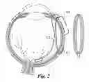 Fig. 03 - Retinal prosthesis