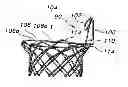 Fig. 01 - INTEGRATED STENT RETRIEVAL LOOP ADAPTED FOR SNARE REMOVAL AND/OR OPTIMIZED PURSE STRINGING