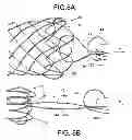 Fig. 04 - INTEGRATED STENT RETRIEVAL LOOP ADAPTED FOR SNARE REMOVAL AND/OR OPTIMIZED PURSE STRINGING