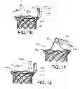 Fig. 06 - INTEGRATED STENT RETRIEVAL LOOP ADAPTED FOR SNARE REMOVAL AND/OR OPTIMIZED PURSE STRINGING